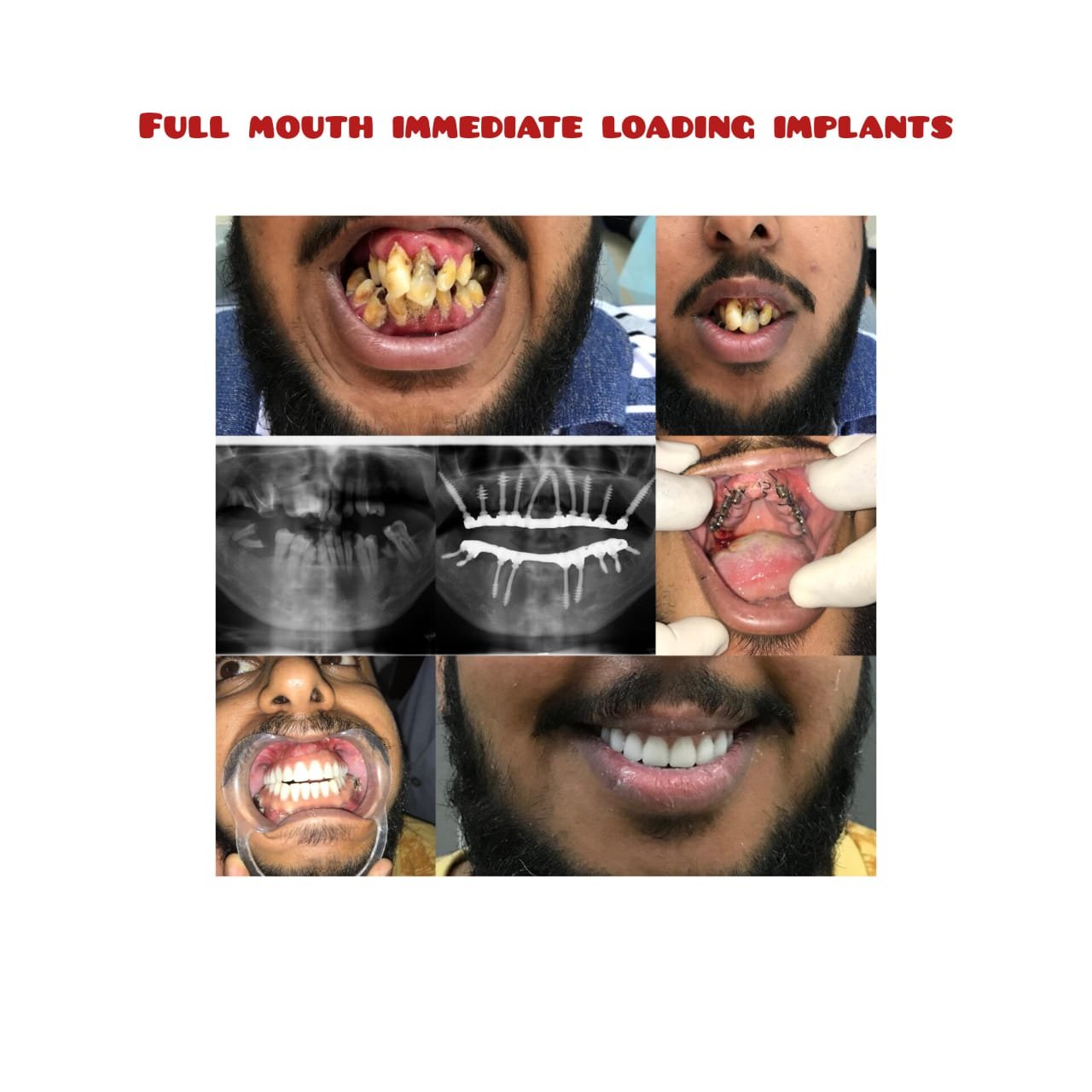 Best dental implants In Hyderabad