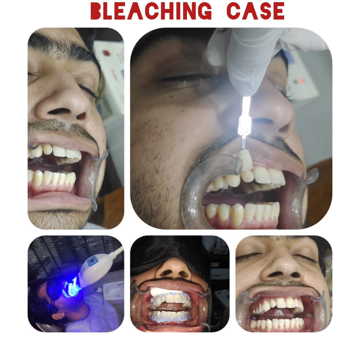 laser teeth whitening in hyderabad