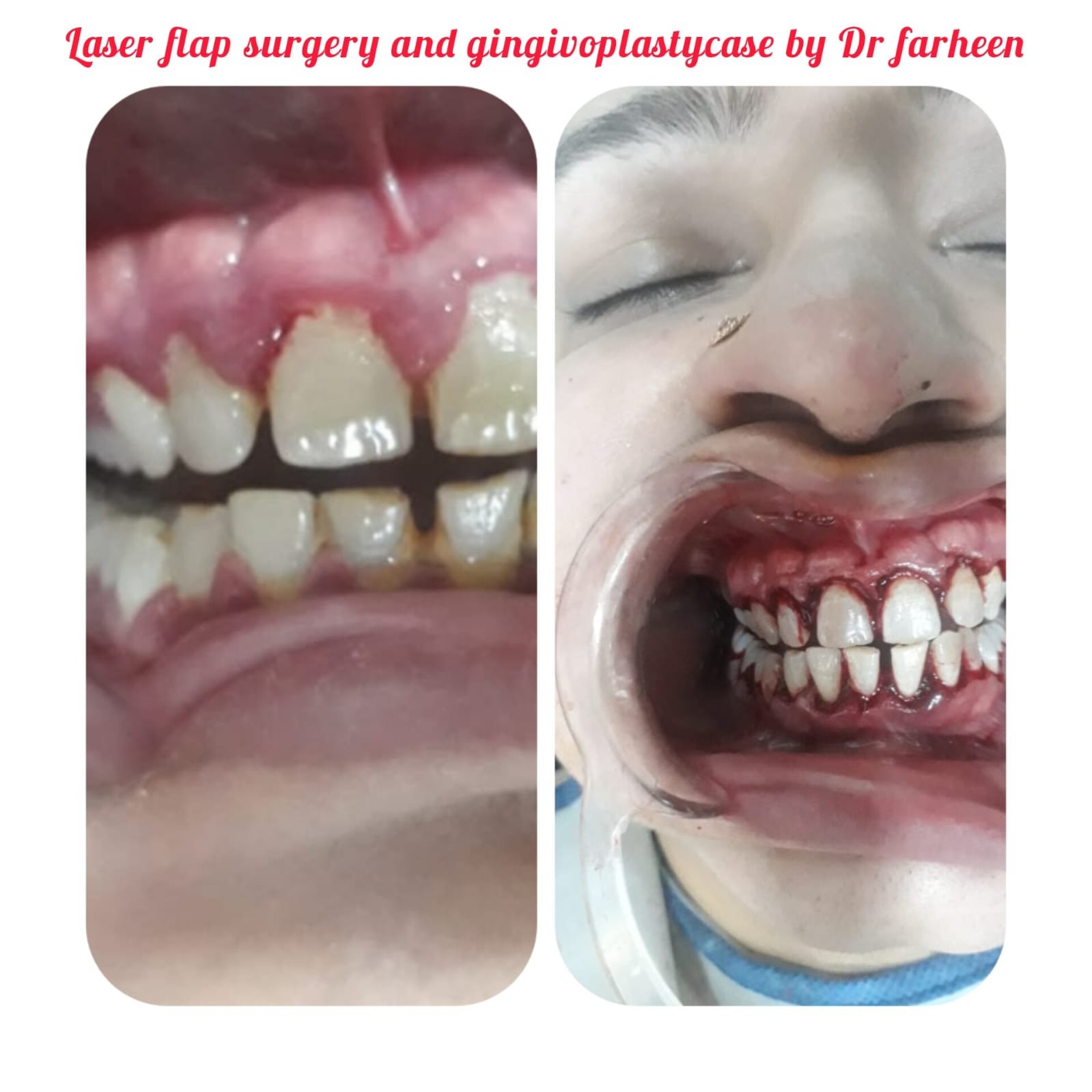 laser gum surgery cost in hyderabad