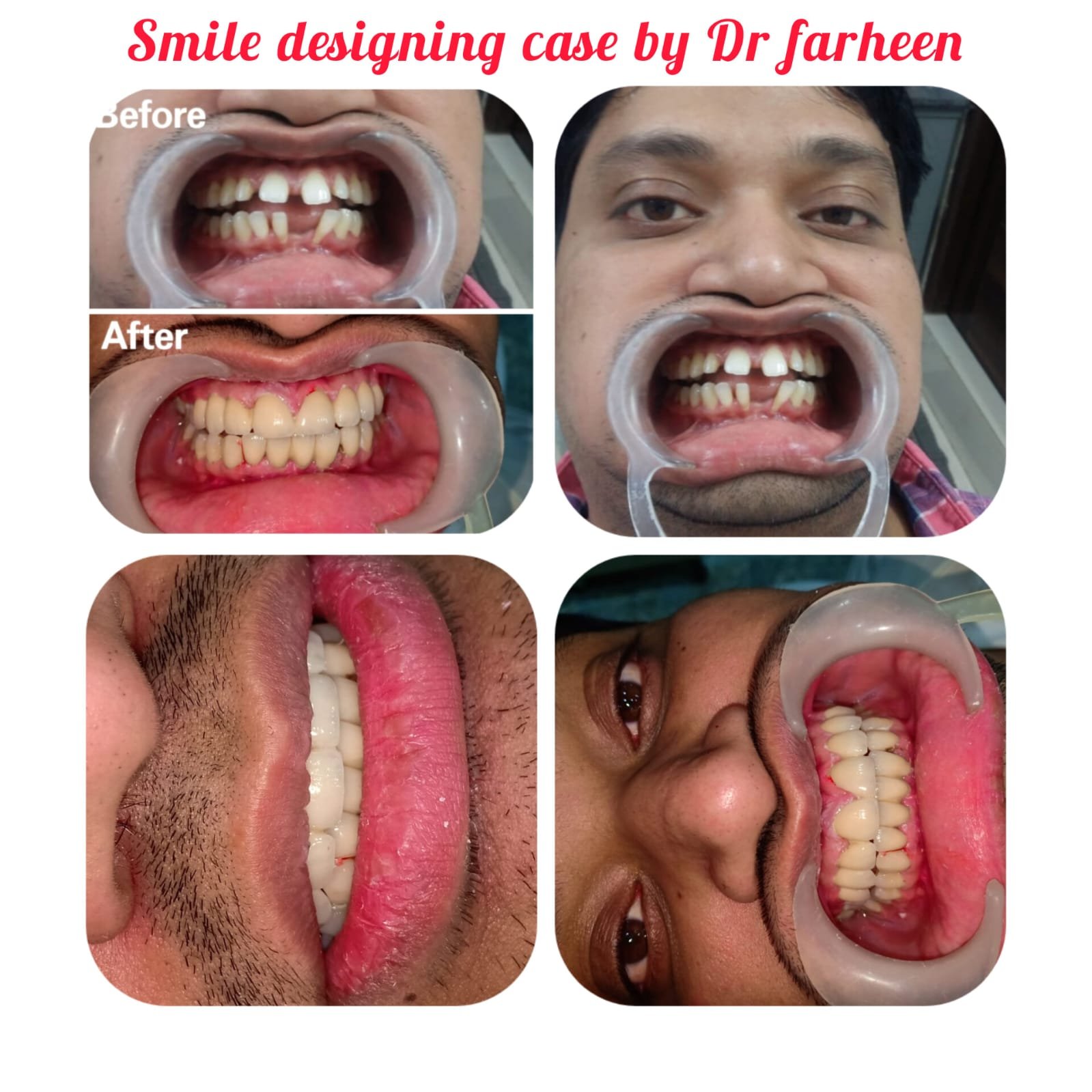 Smile Makeover Surgery